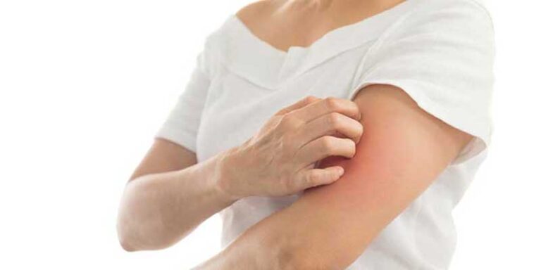 Ayurveda Treatment for Psoriasis – The Ultimate Solution By Dr.Mini Nair