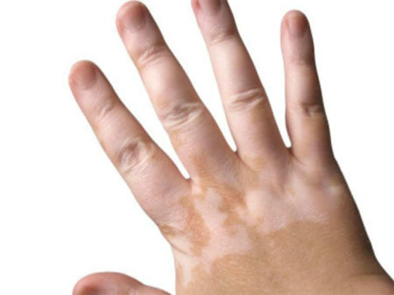 Ayurvedic treatment for white patches(vitiligo), AyurHealing Hospital