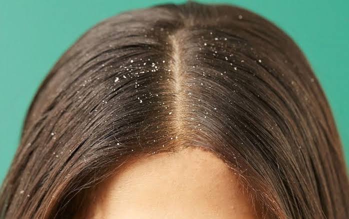 Dandruff (oily and wet) and its Management with Ayurveda