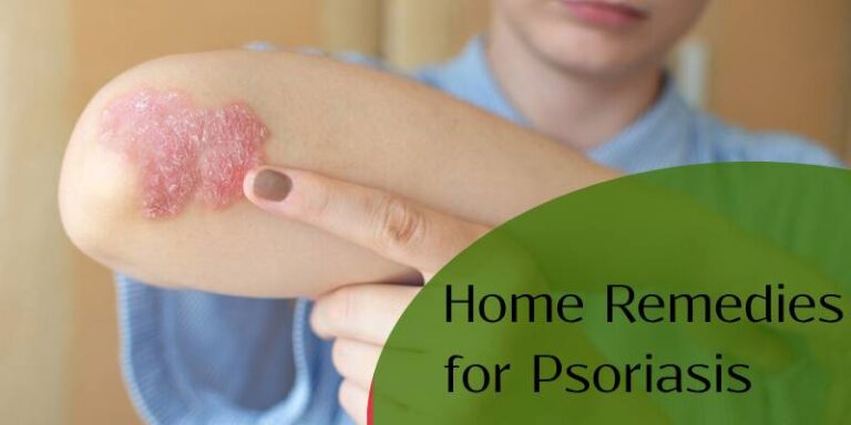 Home Remedies for Psoriasis: Ayurvedic Diet & Tips for Natural Cure