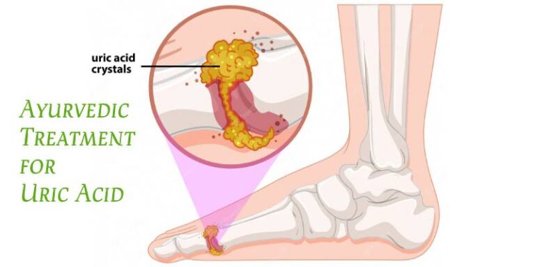 Ayurvedic Treatment for Uric Acid: Natural Remedies