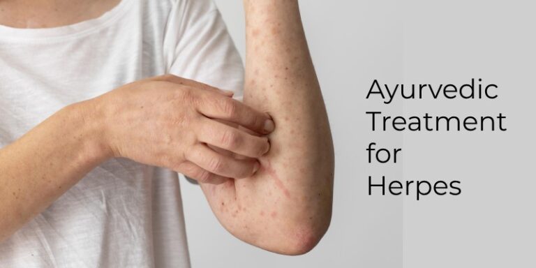 Ayurvedic Treatment for Herpes: Natural Cure Therapies