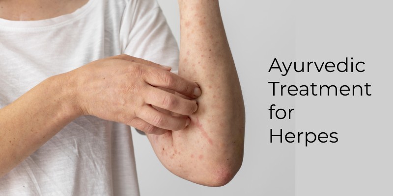 Ayurvedic Treatment for Herpes: Natural Cure Therapies