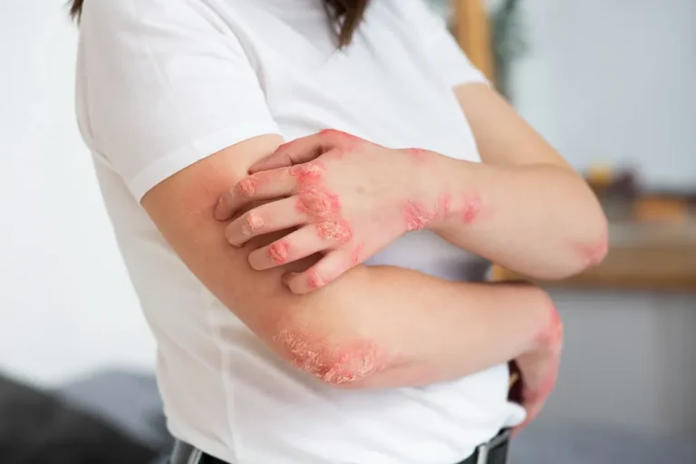 Ayurvedic Treatments for Eczema: A Natural Path to Skin Healing