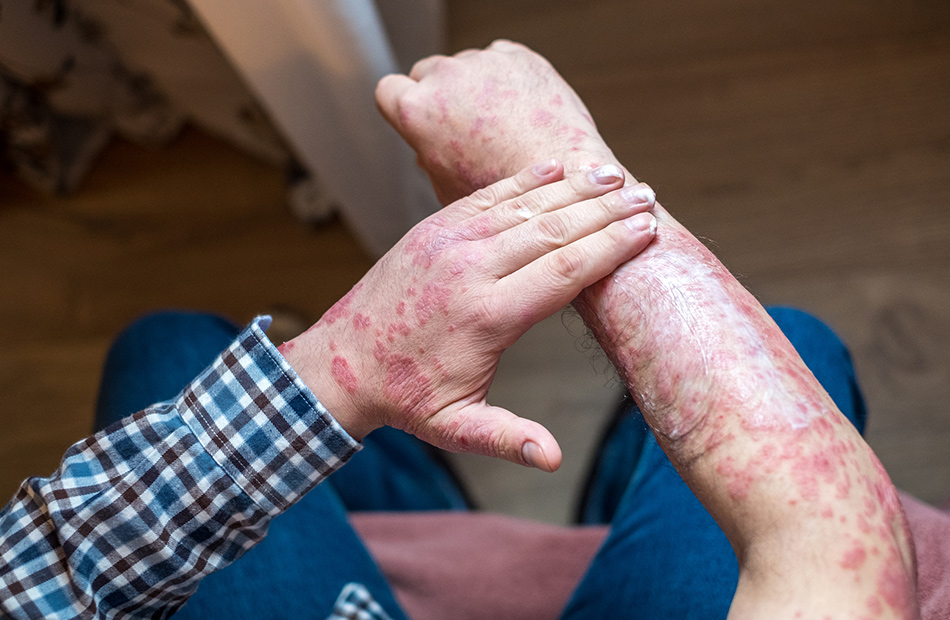 ayurvedic-treatment-psoriasis