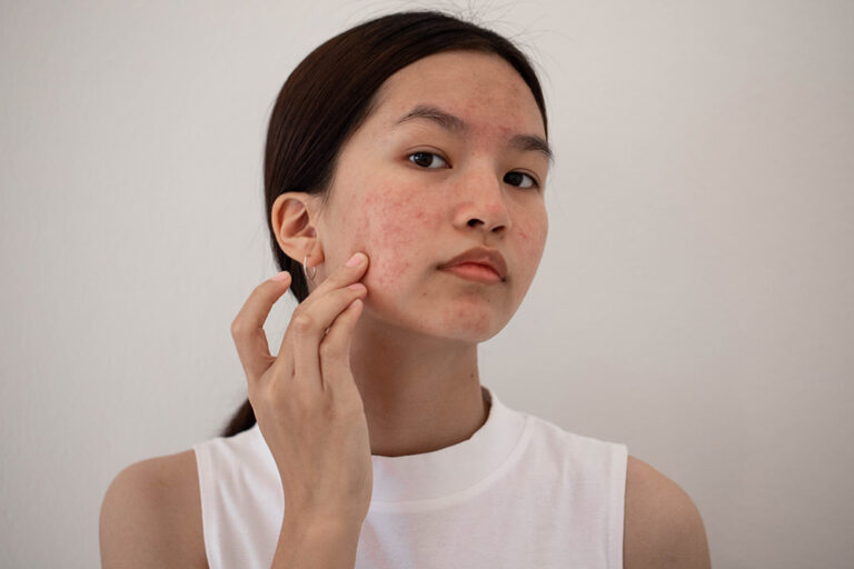 Ayurvedic Treatment for Acne: Natural Healing for Clear and Healthy Skin