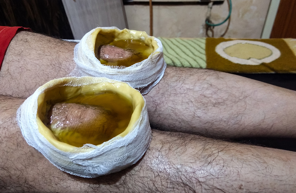 ayurvedic-treatment-for-hridh-vasti