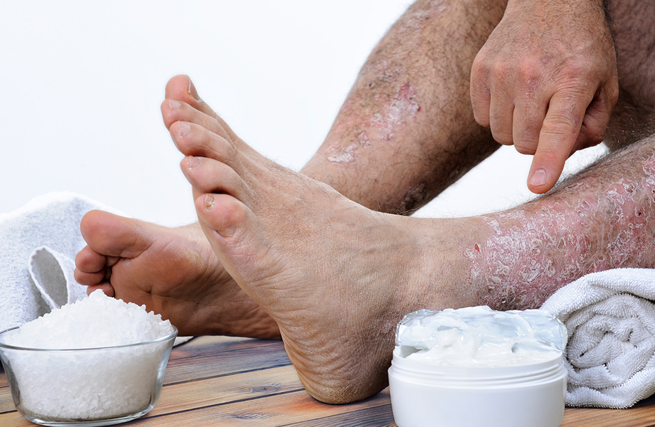 ayurvedic-treatment-for-skin-diseases