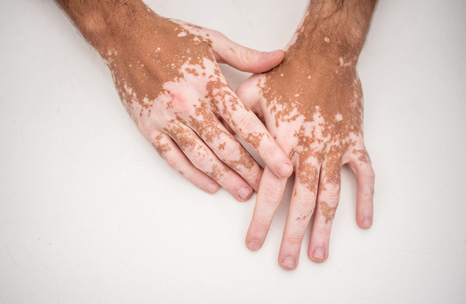ayurvedic-treatment-for-vitiligo-management