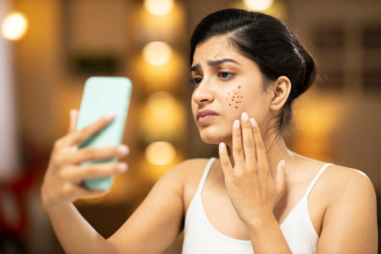Ayurvedic Treatment for Acne: Natural Remedies for Clear & Healthy Skin