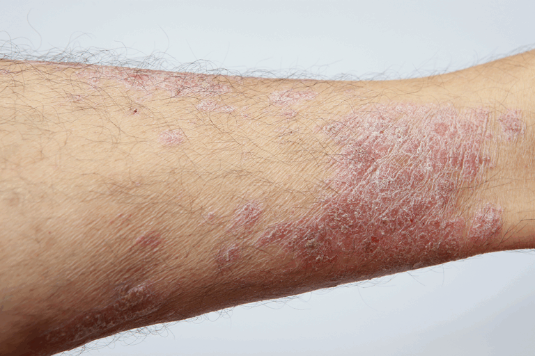 How Ayurveda Treats Fungal Infections Naturally Without Side Effects