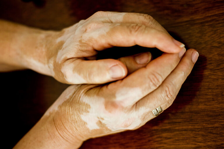 Ayurvedic Treatment for Vitiligo: Restoring Natural Skin Tone through Ayurveda & Siddha Healing