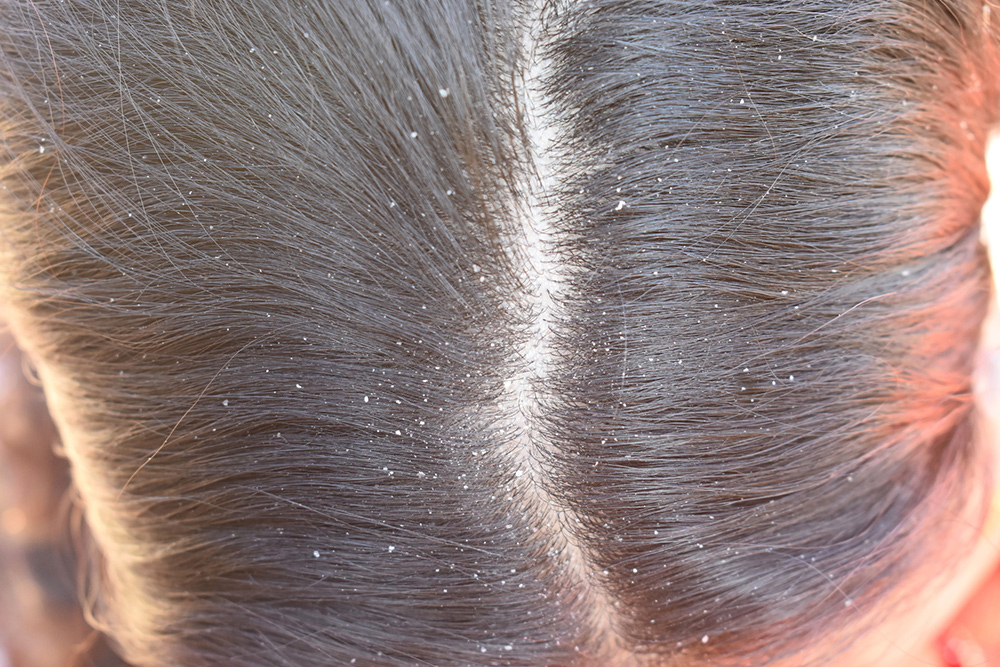 Ayurvedic Treatment for Dandruff at Ayurhealing: A Complete Natural & Permanent Healing Approach