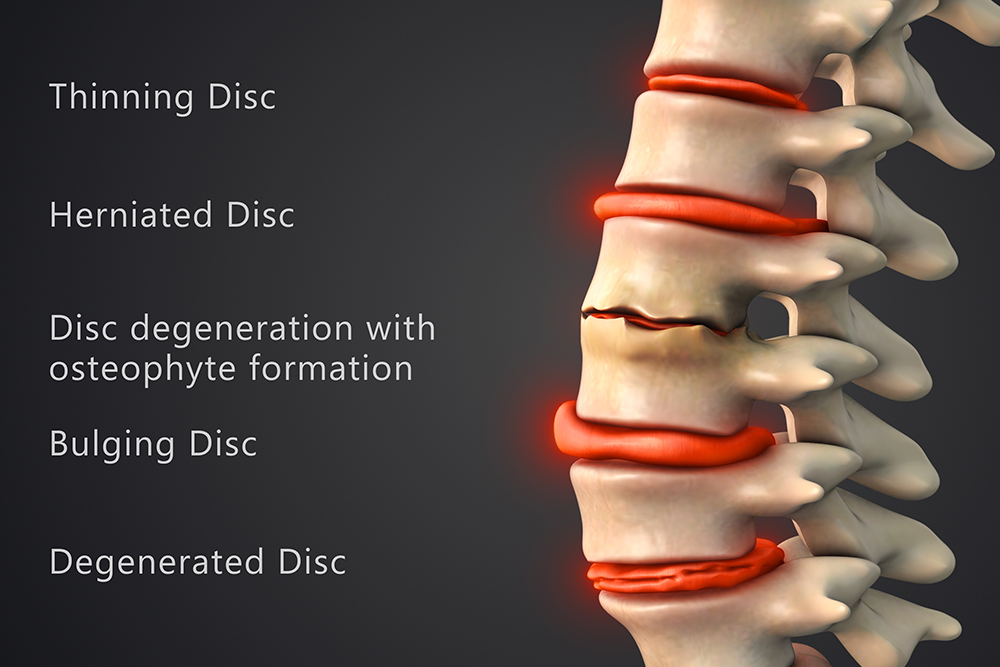 Ayurvedic-Treatment-for-Disc-Degeneration-in-Bangalore-Healing-Spinal-Health-Naturally-at-Ayurhealing