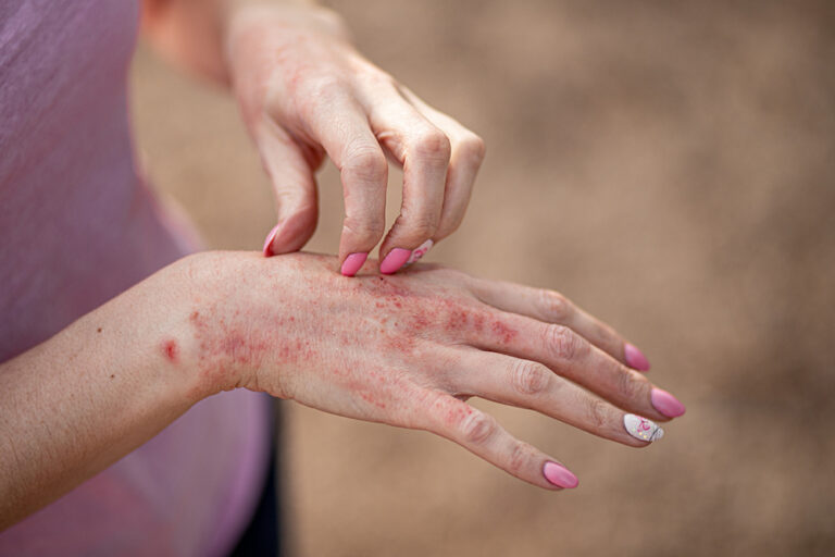 Ayurvedic Treatment for Skin Disorders in Bangalore: Heal Naturally with Ayurhealing