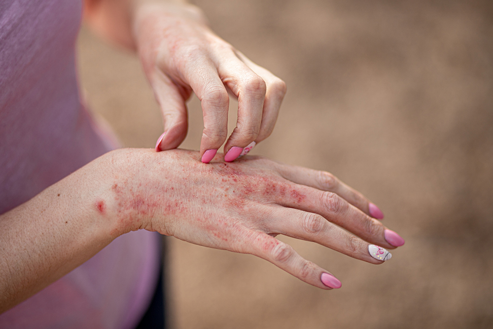 Ayurvedic-Treatment-for-Skin-Disorders-in-Bangalore-Heal-Naturally-with-Ayurhealing