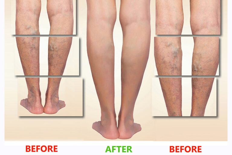 Ayurvedic Treatment for Varicose Veins: A Holistic Healing Approach at Ayurhealing