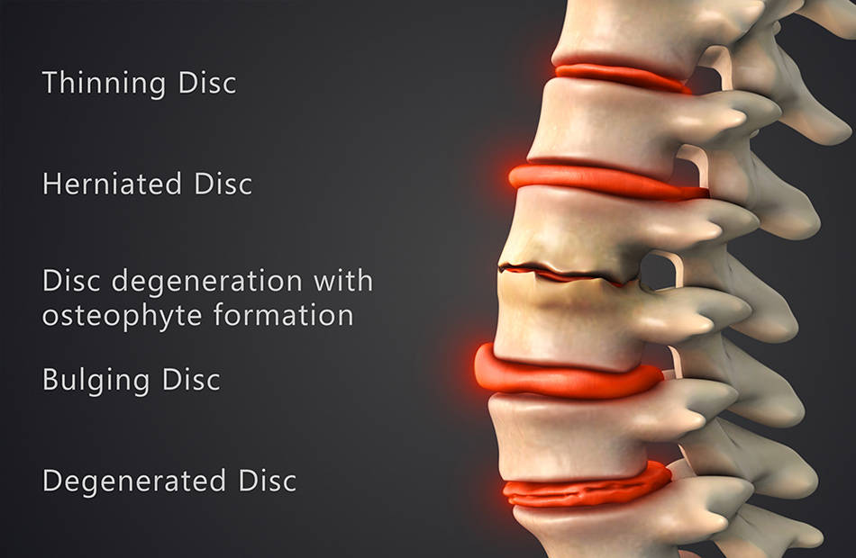 ankylosing-spondylitis