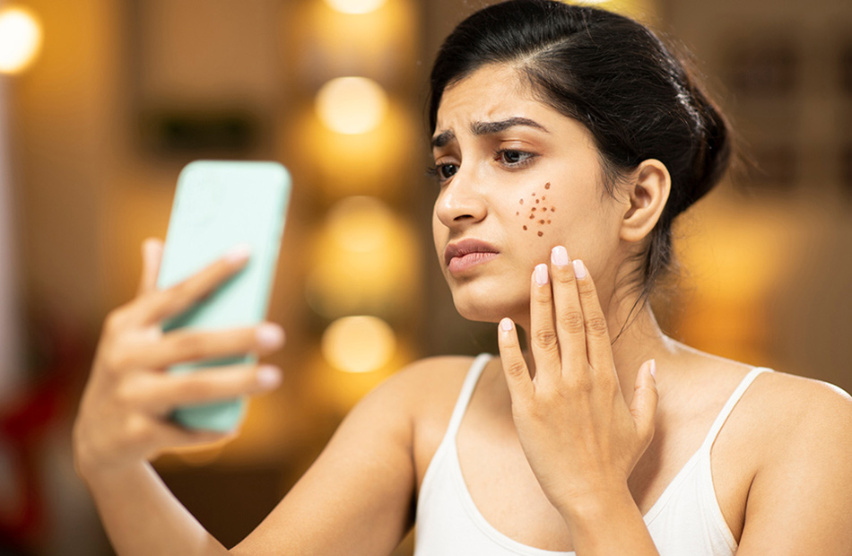 ayurvedic-treatment-for-acne