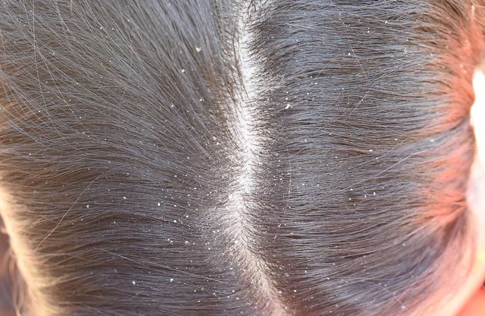 ayurvedic-treatment-for-dandruff
