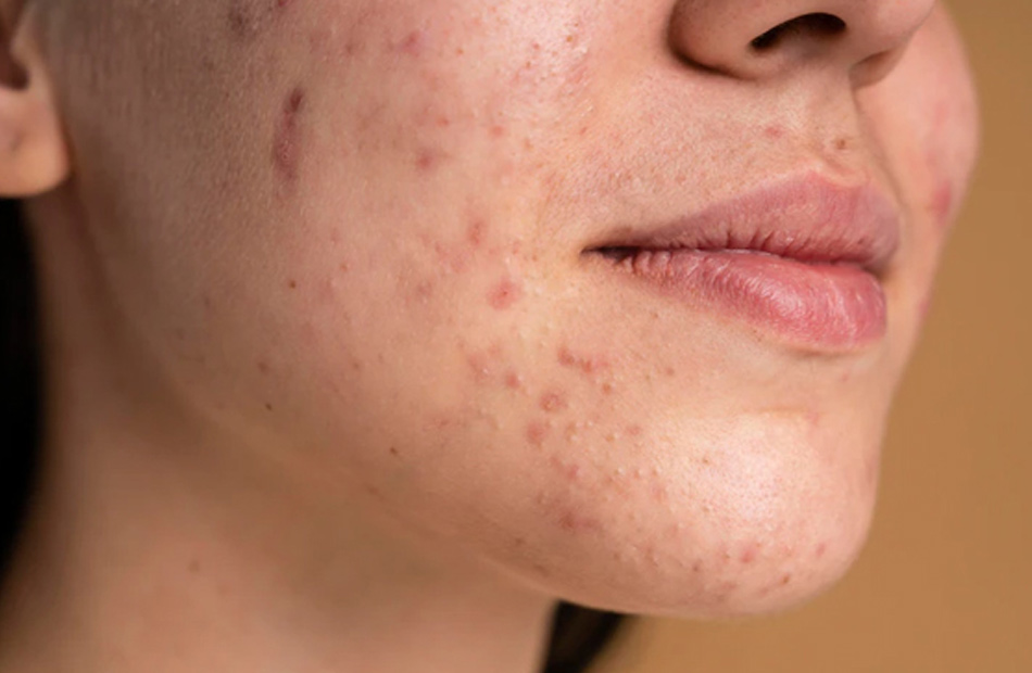 ayurvedic-treatment-for-melasma