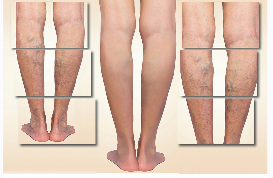 varicose-veins