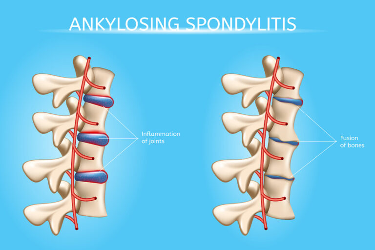 Ayurvedic Treatment for Ankylosing Spondylitis: Natural Relief, Mobility Support & Long-Term Care in Bangalore