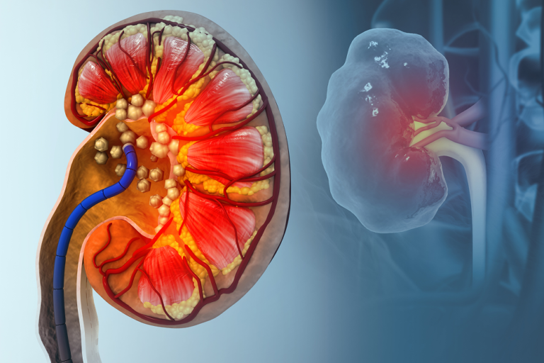 Best Ayurvedic Treatment for Kidney Stones Without Surgery
